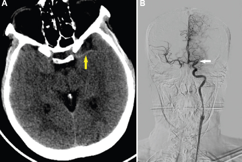 (A) Computed tomography brain plain-hyperdense left middle cerebral artery (yellow solid arrow). (B) Angiogram-absent flow in the left middle cerebral artery (white solid arrow).